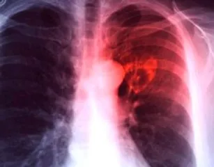 21.69 lakh TB cases notified between Jan-Oct: Centre