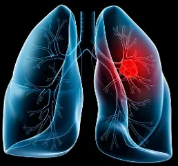 Ozone therapy could cure sepsis-induced lung injury, shows study