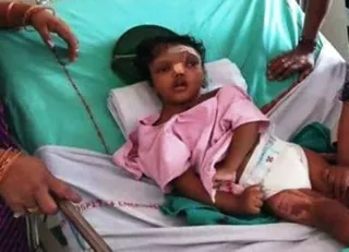One of separated conjoined twins Kalia critical; put on ventilator  