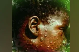 Monkeypox spreads to over 20 countries