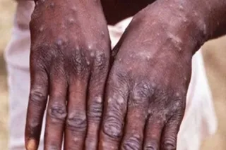 Monkeypox likely to become sexually-transmitted infection in United States