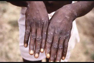 Monkeypox: Infection, spread, prevention and all you need to know