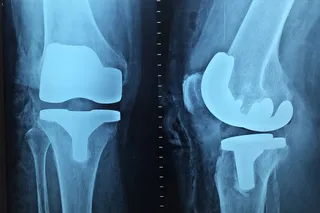 Ortho-cruncher: 75% women ignorant of bone issues, dietary supplements