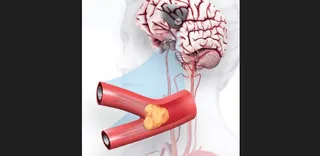 How to prevent stroke that hit actor Mithun Chakraborty