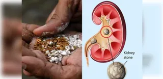 Pan masala consumption can cause larger kidney stones: Experts