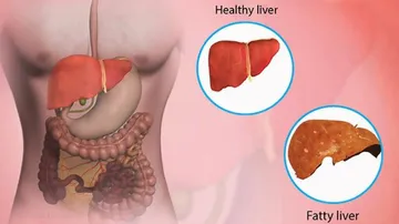 fatty liver disease