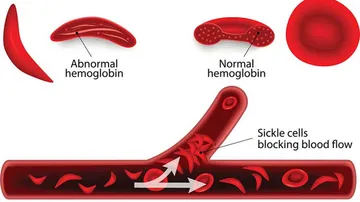 Sickle Cell