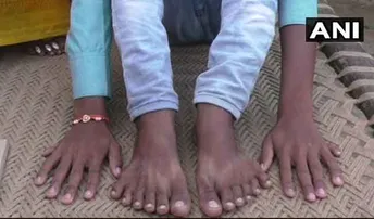 ୨୪ଟି ଅଙ୍ଗୁଳି ପାଇଁ ବିପଦରେ ଜୀବନ