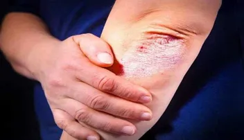 'ସରାଇଅସିସ୍‌' ପାଇଁ ଚିନ୍ତିତ କି ? ଆପଣାନ୍ତୁ ଏହି ସବୁ ଘରୋଇ ଉପାୟ