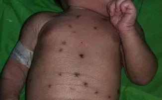 ୫ ଦିନର ଶିଶୁକନ୍ୟାର ଦେହସାରା ଚେଙ୍କ