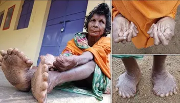 ଆଙ୍ଗୁଠି ସଂଖ୍ୟାରେ ଗିନିଜ୍‌ ବୁକ୍‌ ଅଫ୍‌ ୱାର୍ଲ୍ଡ ରେକର୍ଡ କଲେ ଓଡ଼ିଆ