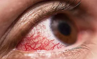 ବ୍ଲାକ୍‌ ଫଙ୍ଗସ: କାରଣ, ନିରାକରଣ ଓ ଲକ୍ଷଣ