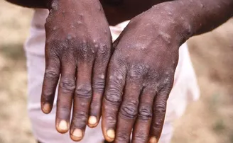 ପୁଣି ଆତଙ୍କ ଖେଳାଇଛି ଏକ ରୋଗ , ‘ମଙ୍କିପକ୍ସ’ ଜାଲରେ ପ୍ରଥମ ଆମେରିକୀୟ    