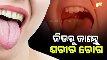 White or Yellow Tongue Coating