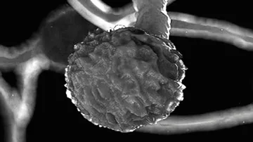 ବାରାଣାସୀରେ ବ୍ଲାକ୍ ଫଙ୍ଗସ୍ ଆତଙ୍କ : ୮ ମୃତ, ୩୦ ଜଣଙ୍କର ଆଖି ବାହାର କରାଗଲା