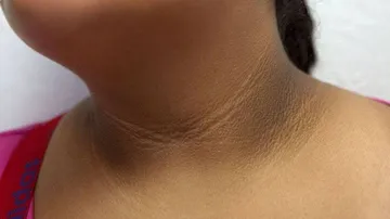 ଚର୍ମର ସଂକେତ କହିବ ମଧୁମେହର ଲକ୍ଷଣ