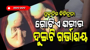 Woman with two uteruses pregnant gives birth twins