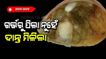 Teeth found in pregnant woman’s stomach