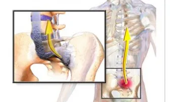 Ankylosing Spondylitis