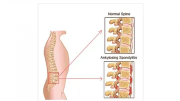 Ankylosing Spondylitis