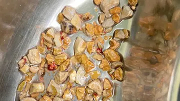 206 Kidney Stones Removed From 56-Year-Old Man