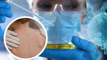 Monkeypox outbreak: Govt alerts NCDC, ICMR to close watch, send samples to NIV. See details here