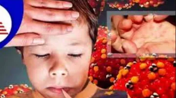 Every day 4-5 patients with Tomato flu-like symptoms are coming to AIIMS