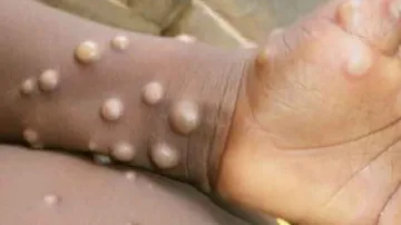 Guidlines for monkeypx disease