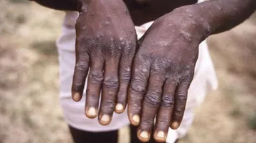  30-year-old UAE Returnee Tests +ve for Monkeypox in Kozhikode