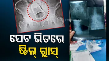 Doctors take out steel glass from patient's stomach in Ganjam