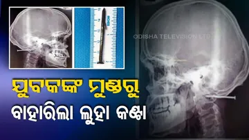 doctors remove two inch nail from mans head