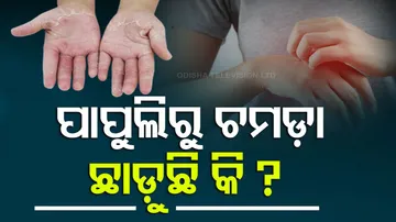 ପାପୁଲିରୁ ଚମଡ଼ା ଛାଡୁଛି କି ?