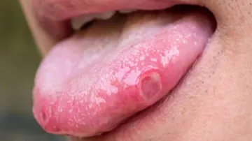 Health Tips: ପାଟିରେ ହେଉଛି କି ଏମିତି; ହୋଇପାରେ କର୍କଟ