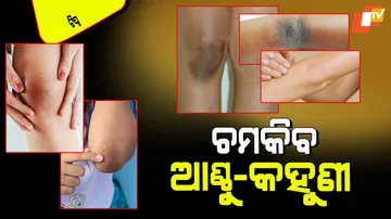 Remove darkness from elbows and knees with homemade pack