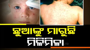 Measles Outbreak In India