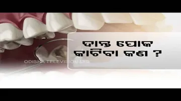 Reason & Treatment Of Dental Cavities