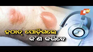 Doctor Doctor - Discussion On Burn Injuries - Dr. Jayant Das