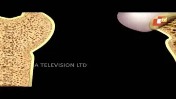 ଅଷ୍ଟିଓପୋରେସିସ: କାରଣ, ଲକ୍ଷଣ ଏବଂ ଚିକିତ୍ସା | Osteoporosis: Causes, Symptoms & Treatments