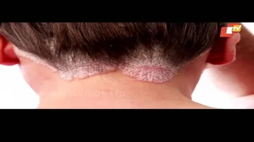 Psoriasis: Causes, Symptoms & Treatment | ଚର୍ମରୋଗର କାରଣ, ଲକ୍ଷଣ ଓ ଚିକିତ୍ସା ବିଷୟରେ ଜାଣନ୍ତୁ