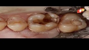 ଦାନ୍ତ ଝଡ଼ିଯାଉଛିକି? ଜାଣନ୍ତୁ କେମିତି କରିବେ ଏହାର ଚିକିତ୍ସା