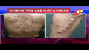 Doctor Doctor  Causes, Symptoms & How To Cure Cirrhosis Arthritis