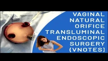 Doctor Doctor | First successful vNOTE Surgery in Odisha