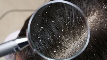 How to prevent dandruff during winter