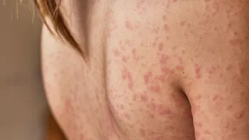 Warning signs on your skin: 7 symptoms that may indicate uncontrolled diabetes