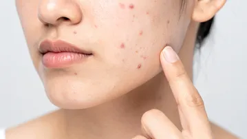 Common skin problems