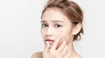 Probiotics An Effective Alternative To Treat Acne