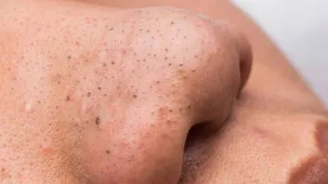 How to Get Rid Of Blackheads Using Homemade Ingredients?