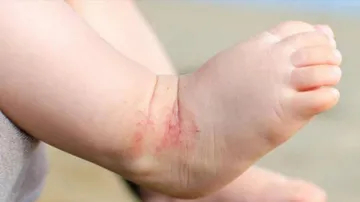 Using Daily Moisturisers Cannot Prevent Eczema In Babies