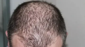 Hair loss