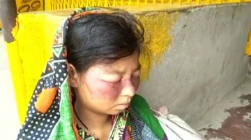 Odisha: Woman Suffers Severe Facial Rashes & Vision Loss, Blames Fairness Cream